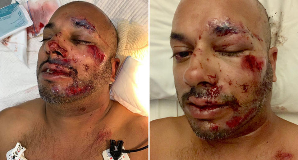 Mr Pires is considering legal action after suffering a broken cheek and broken nose. Source: Supplied