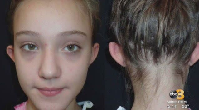 Bella said she was teased for her ears. Pictured before surgery. Photo: 8News