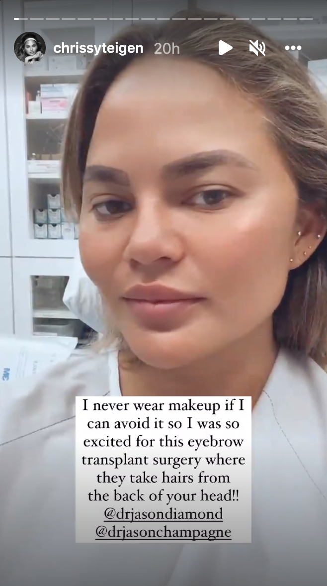 Chrissy Teigen reveals she's undergoing eyebrow replacement surgery. (Photo: Instagram/Chrissy Teigen)