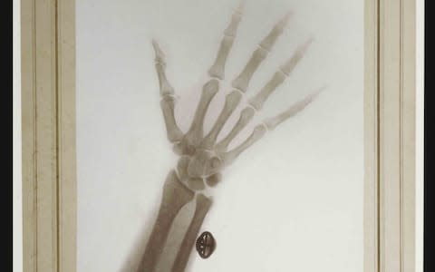 X-ray of the Hand and Wrist of Nicholas II, Emperor of Russia, 1898 - Credit: Harvard Medical Library