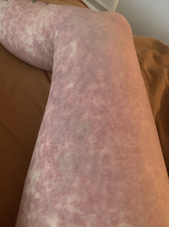 The image shows a close-up of a person's leg with a mottled, blotchy skin condition