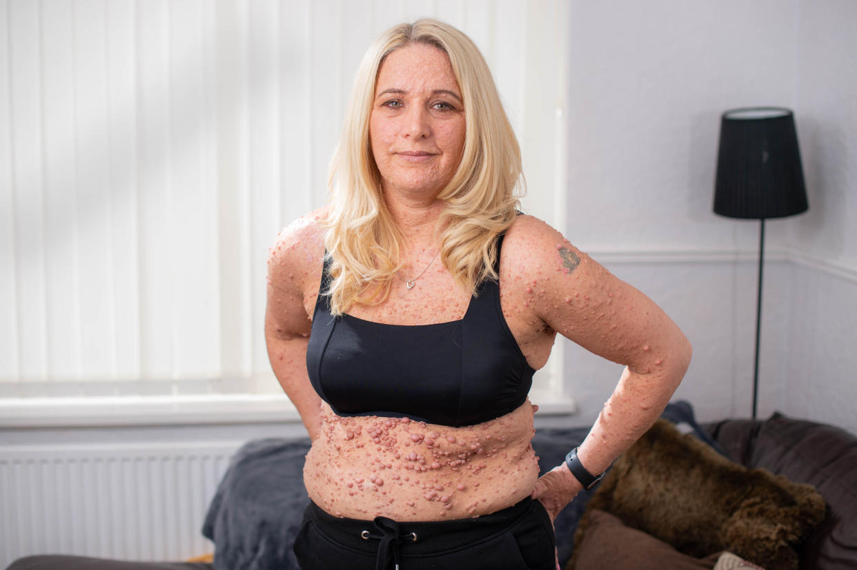 Rachael Reynolds suffers from neurofibromatosis type 1 (NF1), which has left her body covered in bubble-like lesions [Photo: SWNS]