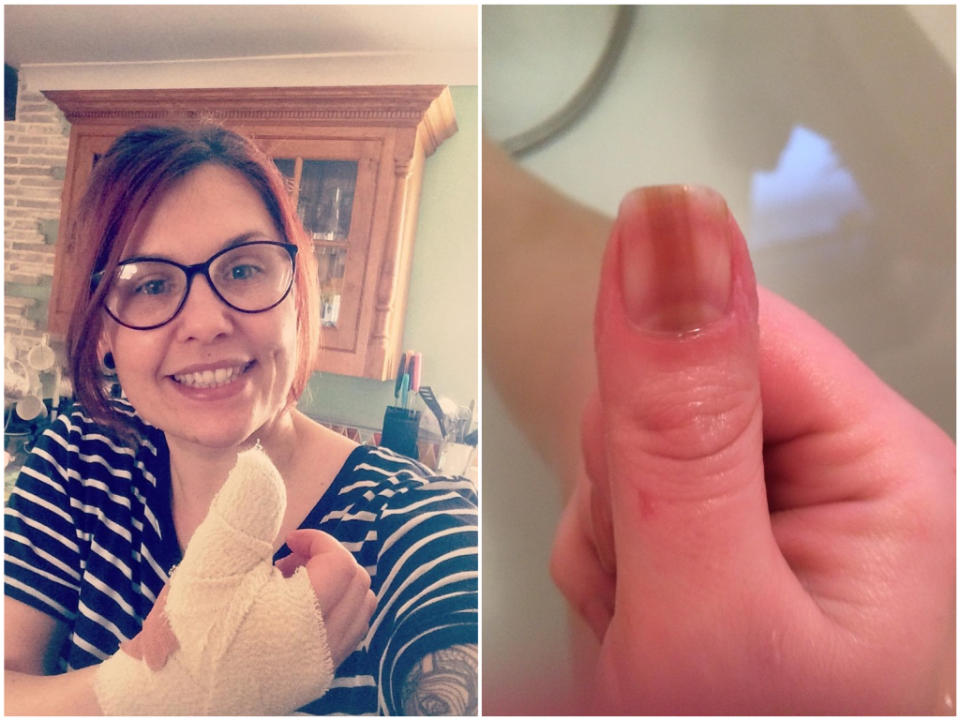 Alana Severs has revealed a line on her fingernail was a sign of cancer. (SWNS)