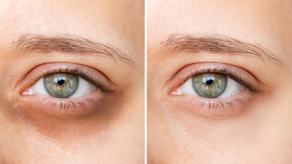 Dark-Circle-Before-After-Closeup-Stock-Photo