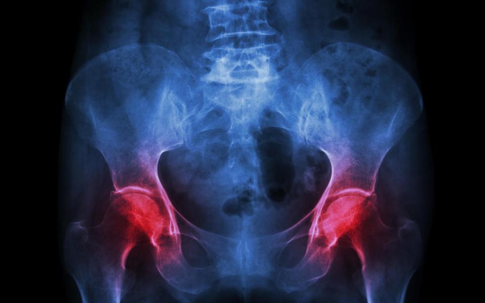 Hip x-ray - Credit: Alamy 