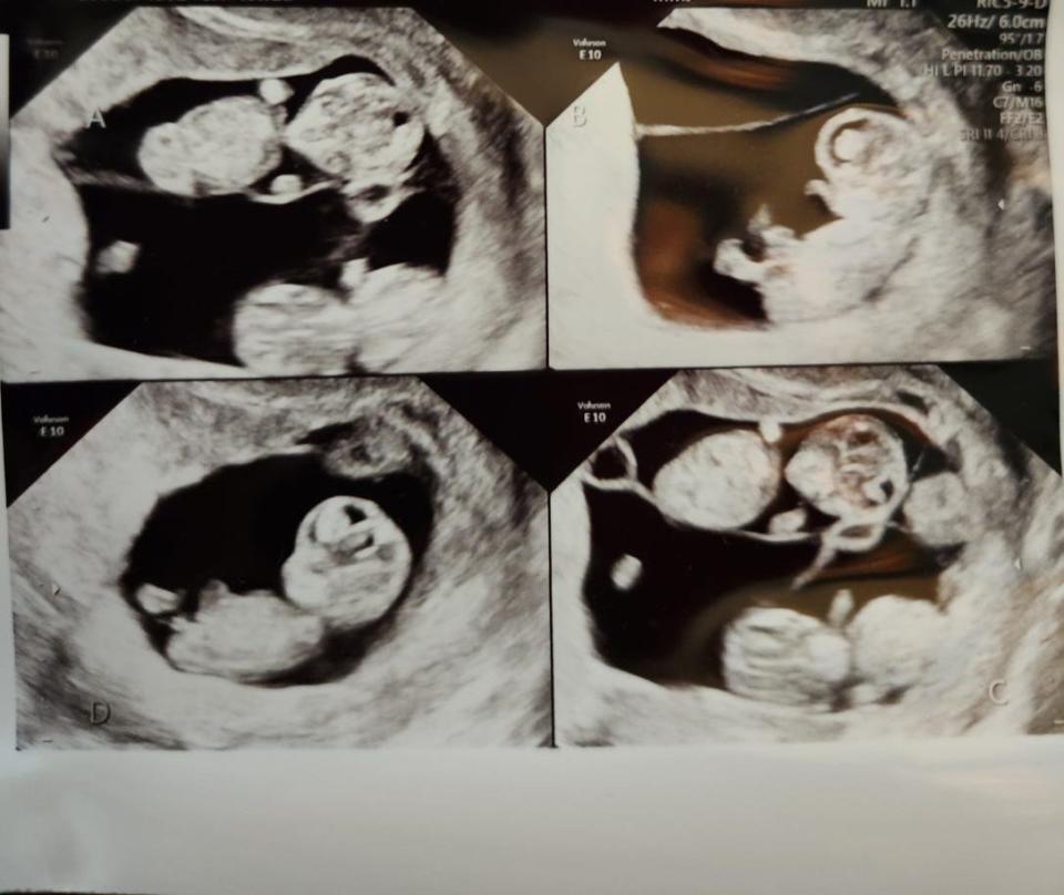 A sonogram shows Mercedes Sandhu's identical quadruplets inside her uterus.