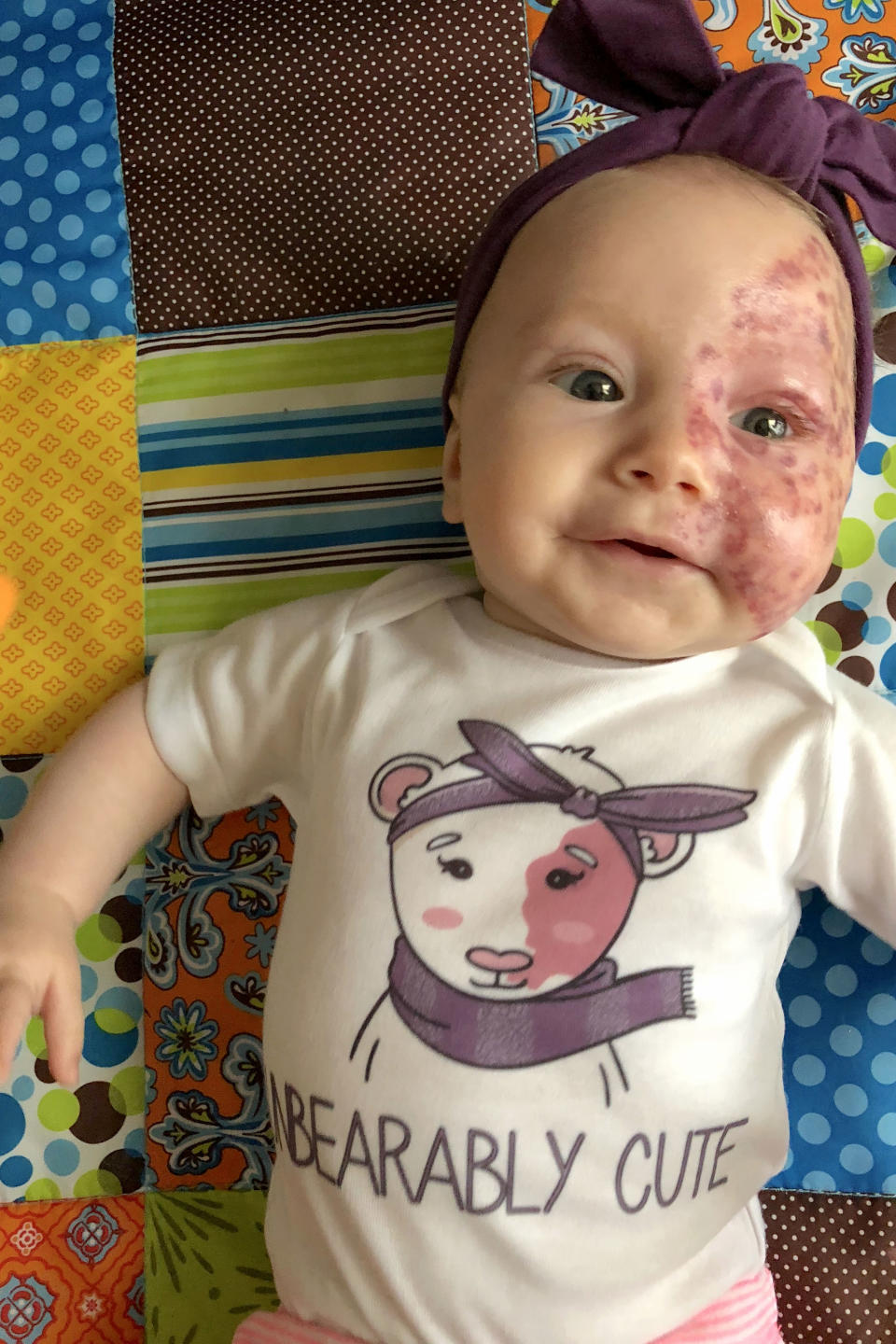 Amanda has also created a clothing range to raise awareness for birth marks. Photo: Caters