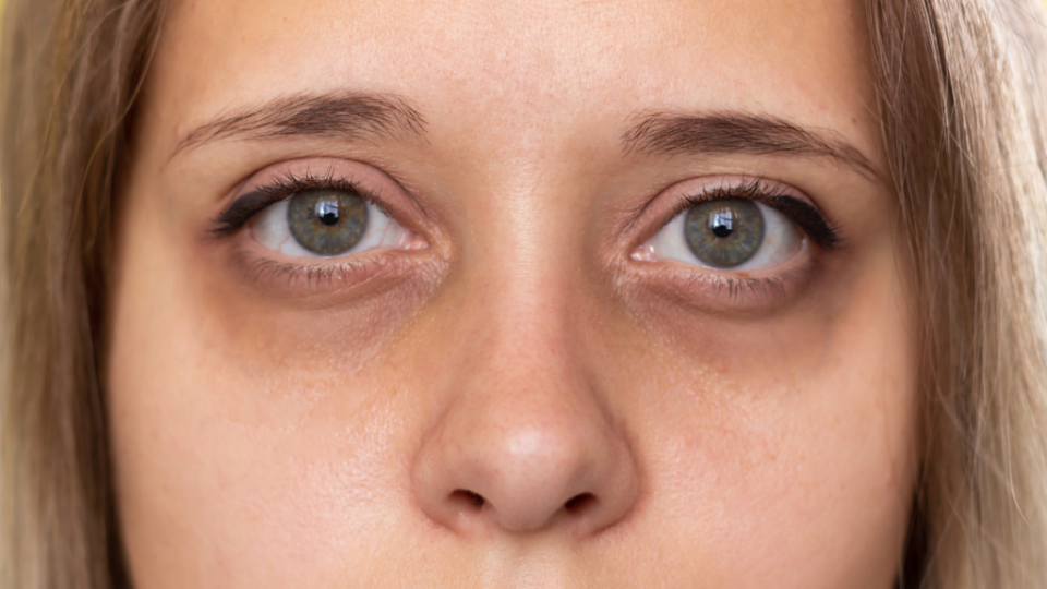 眼袋通常會和淚溝一起成形。(圖片來源／canva)