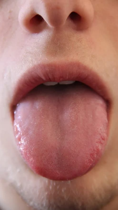 中醫師鄒瑋倫表示，從「舌相」就可以看出過敏和武漢肺炎的差別。（示意圖／取自pixabay）