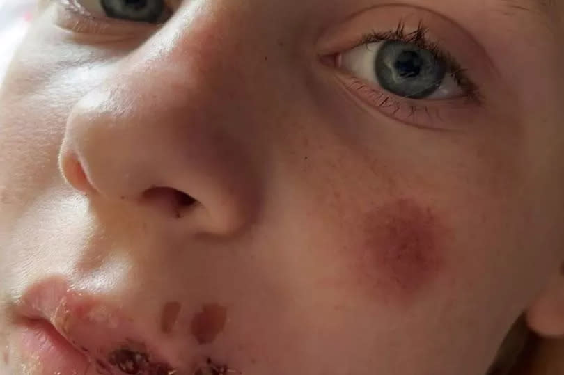 The schoolgirl has been left with a disfigurement on her lip