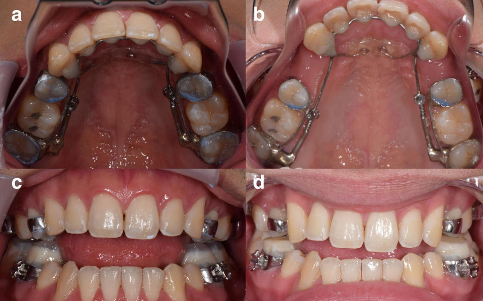 Photos of a 21-year-old man who has been affixed with an AGGA device and was examined by Dr. Kasey Li, a California maxillofacial surgeon. Li says images A and C show the patient at the start of his AGGA treatment and images B and D show the end, after the AGGA created gaps behind his canines. / Credit: Kasey Li