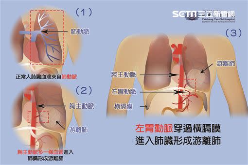 極為罕見的肺內游離肺。（圖／台中慈濟醫院提供）