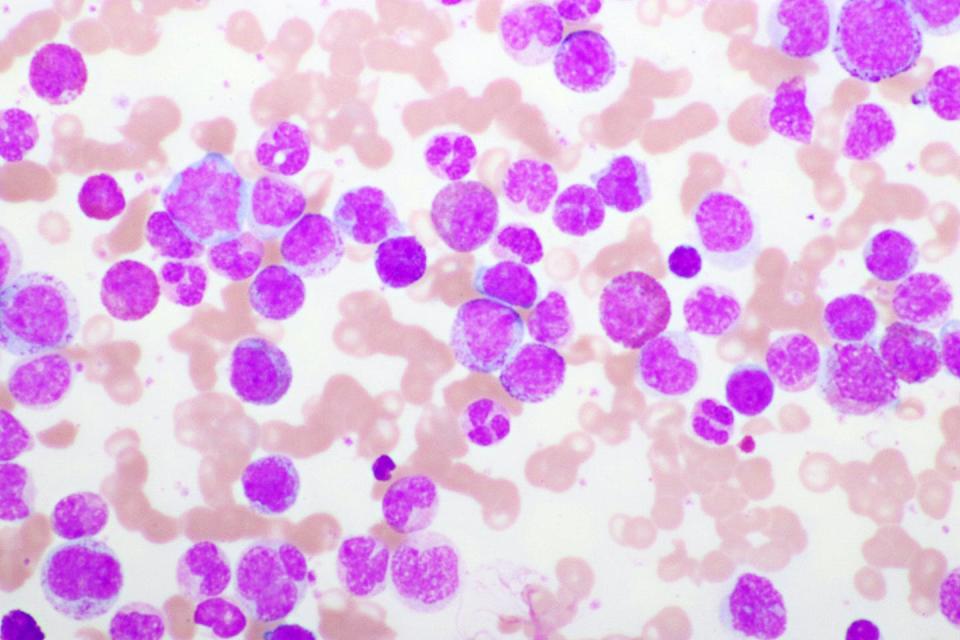 Acute promyelocytic leukemia, as shown in this microscopy image, can be treated with differentiation therapy. <a href="https://www.gettyimages.com/detail/photo/acute-promyelocytic-leukemia-cells-royalty-free-image/1417347912" rel="nofollow noopener" target="_blank" data-ylk="slk:jarun011/iStock via Getty Images Plus;elm:context_link;itc:0;sec:content-canvas" class="link ">jarun011/iStock via Getty Images Plus</a>