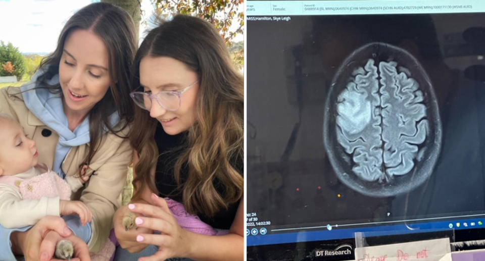 Left, sisters Zoe and Skye can be seen with Skye's youngest child. Right, a brain scan shows Skye's tumour size of chicken egg.