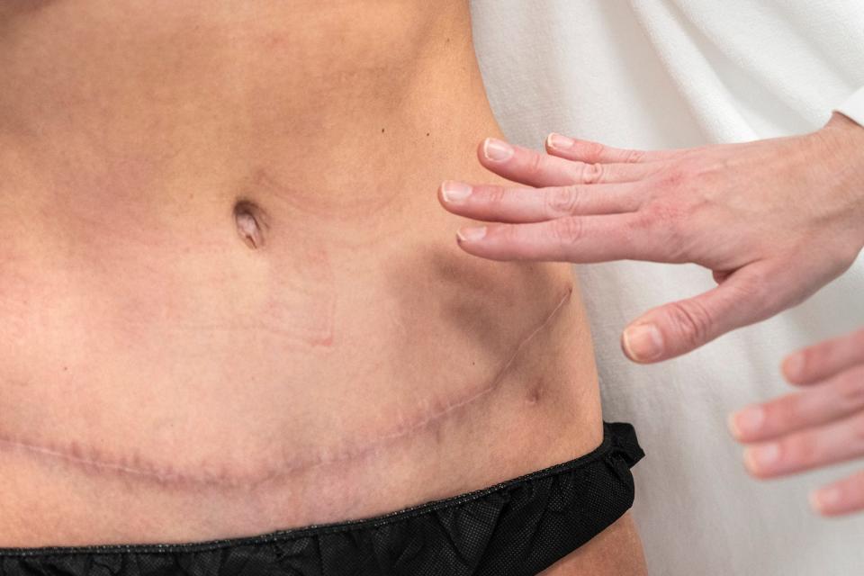 Dr. Elisabeth Potter looks at the scar on Michael Catanese's belly where the blood vessels, fat and skin were taken to create her new breasts. Catanese's abdominal muscles were unaffected by this, and she is able to work out the way she did before the surgery.