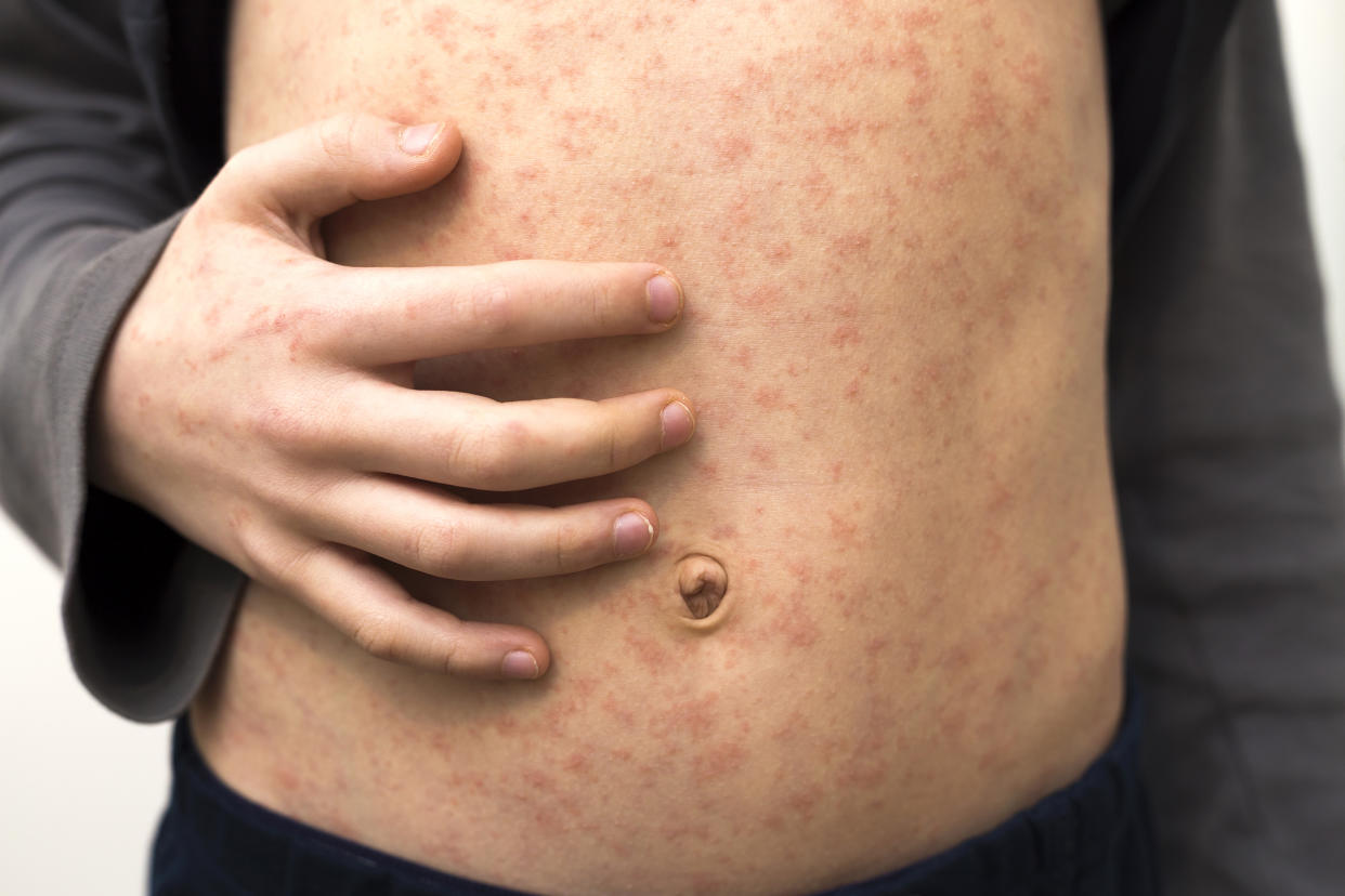 Photos of measles in children and how to treat measles in children (Bilanol / Getty Images stock)