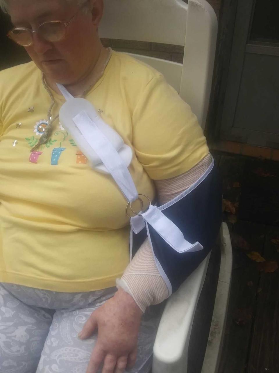 Donna Roland broke her arm in two places after tripping and falling in front of the Lexington County Auxiliary Administration building. Courtesy The Goings Law Firm