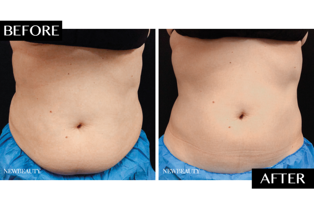 Fort Worth CoolSculpting, Non-Surgical Fat Reduction