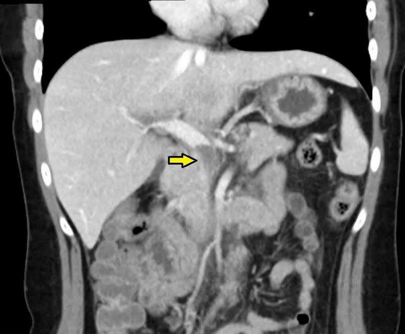 電腦斷層顯示，病人三條靜脈交會處有嚴重血栓。（圖／台北慈濟醫院提供）
