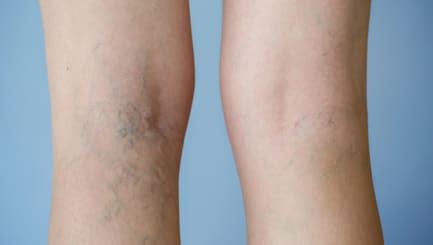 Varicose veins on a leg