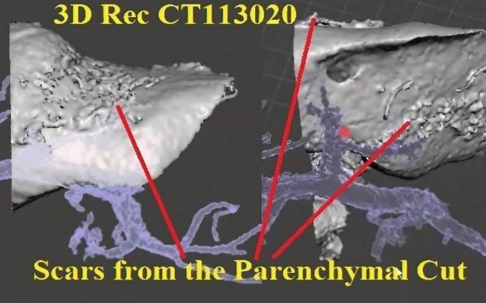 The scan shows irregularities on both sides of the left side of the liver