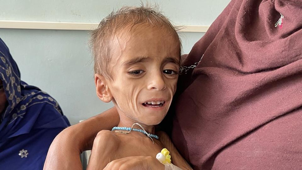 Un niño recibe tratamiento médico en un hospital en Kandahar, Afghanistan, el 14 de Octubre del 2021