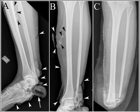 This image shows the foot and leg of a bombing victim whose foot bones were broken in several places, and whose heel bone was destroyed. In panels A and B, the black arrowheads point to shrapnel, and the white arrowheads point to the soft tissu