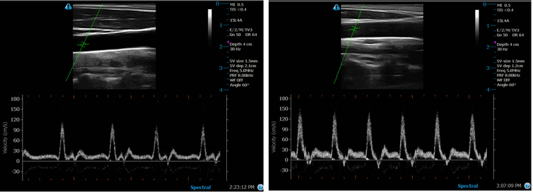 Black and white ultrasound images showing blood flow.