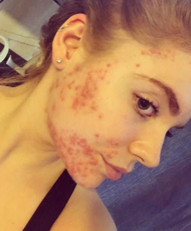 Rachel reveals her acne saw her suffering from depression and anxiety. Photo: Instagram