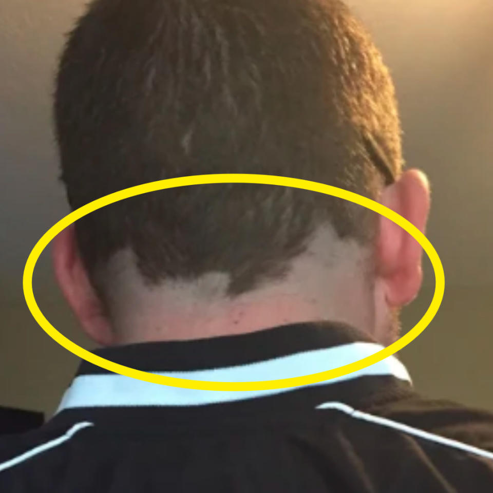 Close up of a hairline thats very, very crooked and uneven