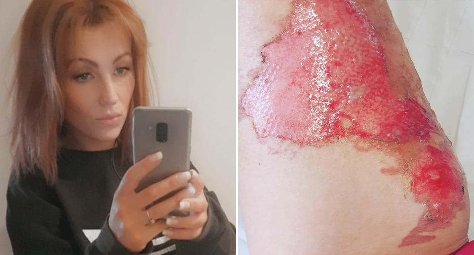Pictured left is Rosie Chapman. Right is an image of the burns on her leg.