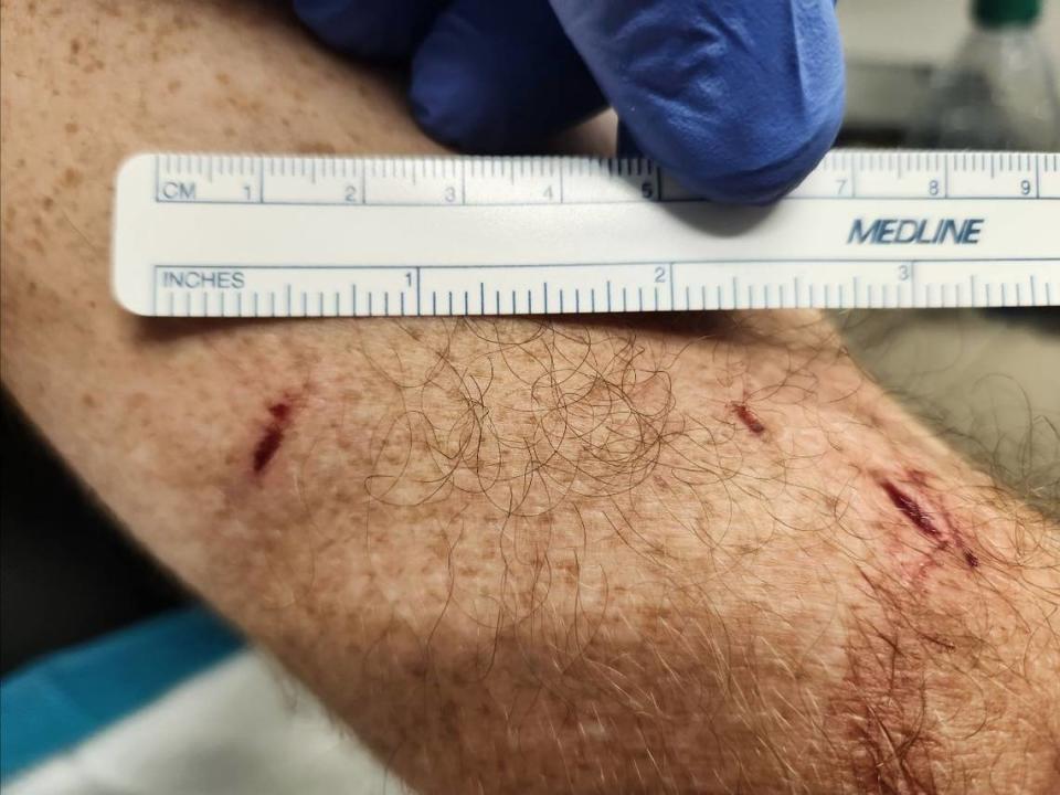 A bear bit a man who was relaxing in a hammock and left a minor 2-3 inch long injury. 
