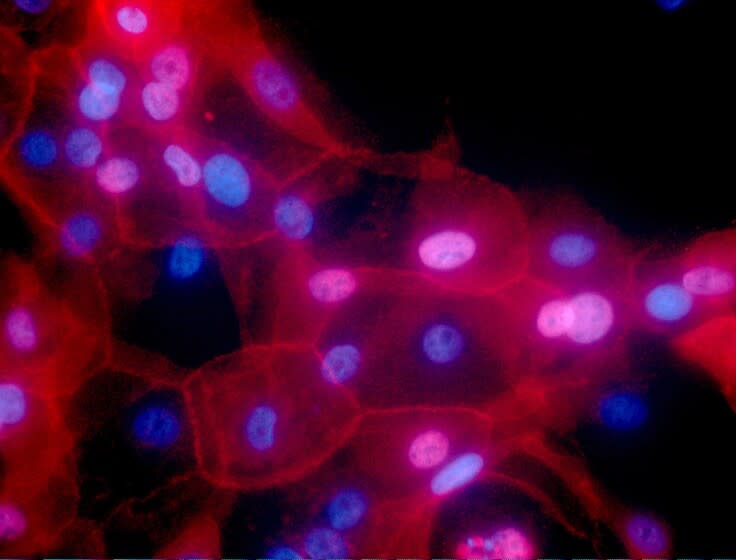 FILE - This undated fluorescence-colored microscope image made available by the National Institutes of Health in September 2016 shows a culture of human breast cancer cells. A study discussed at the 2022 meeting of the American Society of Clinical Oncology suggests some low-risk breast cancer patients can omit radiation after lumpectomy. (Ewa Krawczyk/National Cancer Institute via AP)