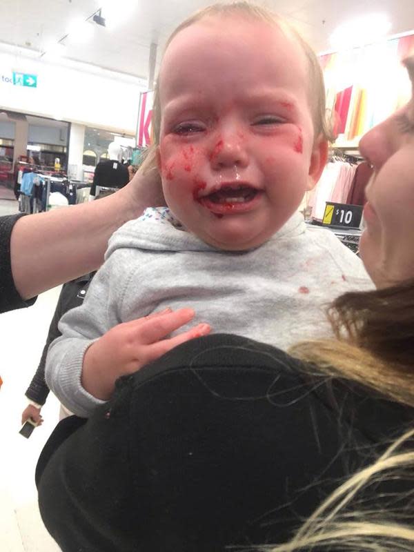 The child was left bleeding from both her eye and her nose, sparking concerns that she may go blind. (Photo: Courtesy of Hayley Skye Smith)