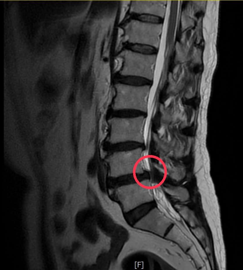 磁振造影顯示黃先生腰椎滑脫，神經受到壓迫。