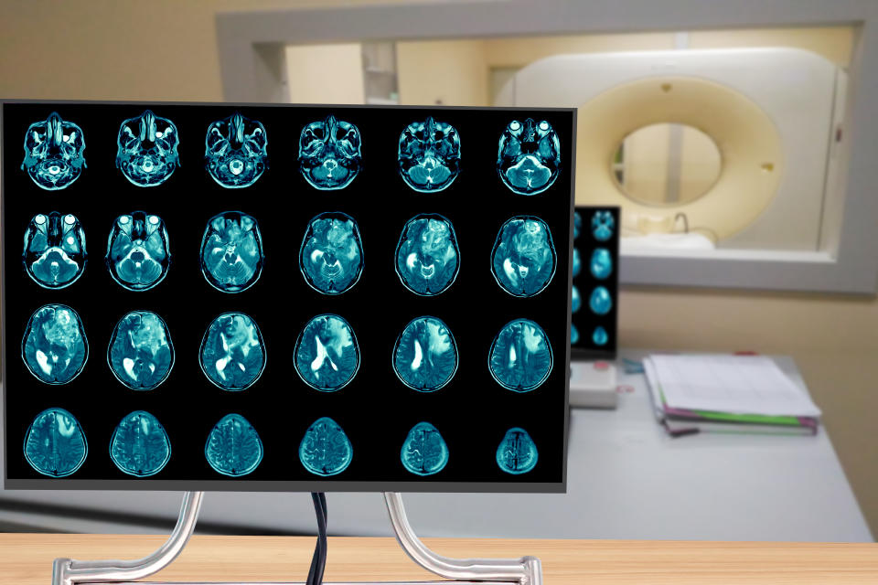 Magnetic resonance imaging Finding  5 cm isodense mass with ill-defined margin and surrounding edema at Left frontal lobe. Glioblastoma, brain metastasis.science and education mri brain background.