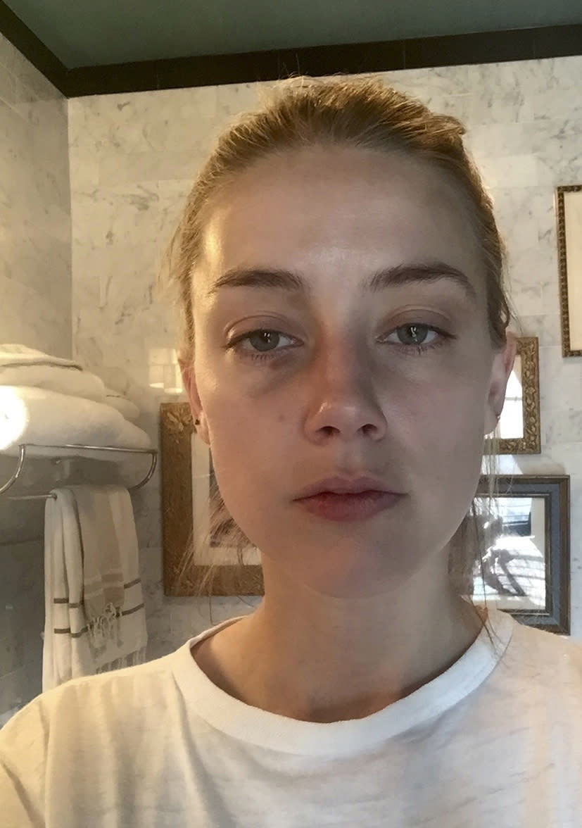 In this undated photo released by London's High Court, showing Amber Heard displaying injuries said to have been sustained during an incident in which actor Johnny Depp has admitted to "accidentally" head butting her at their Los Angeles penthouse. The photo has been referred to as an exhibit at the High Court in London, in the hearing of Johnny Depp's libel suit over an April 2018 article that said he had physically abused ex-wife Amber Heard, and called him a “wife-beater.” He strongly denies ever hitting Heard.(Court Photo via AP)