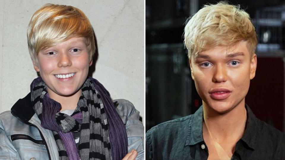 Jack Vidgen has already set the record straight, saying he’s only had lip fillers and no plastic surgery. Photo: Getty Images