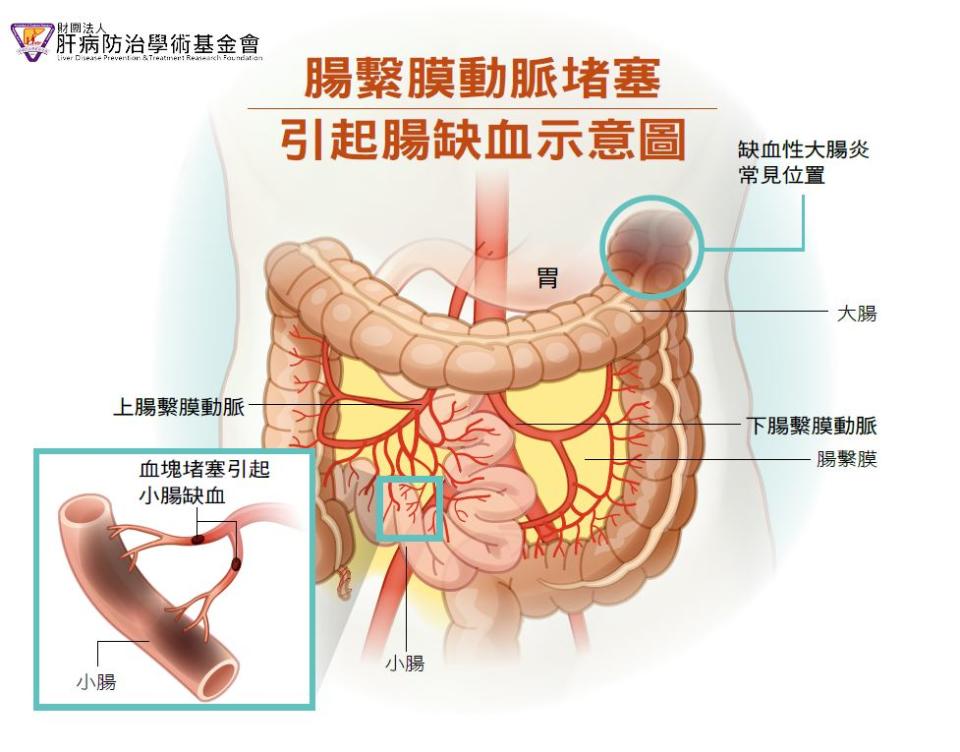 腸繫膜動脈堵塞引起腸缺血示意圖