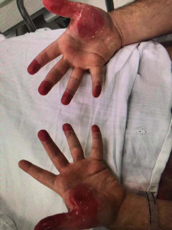 Pictured are burns on a man's fingertips. Source: USA Today