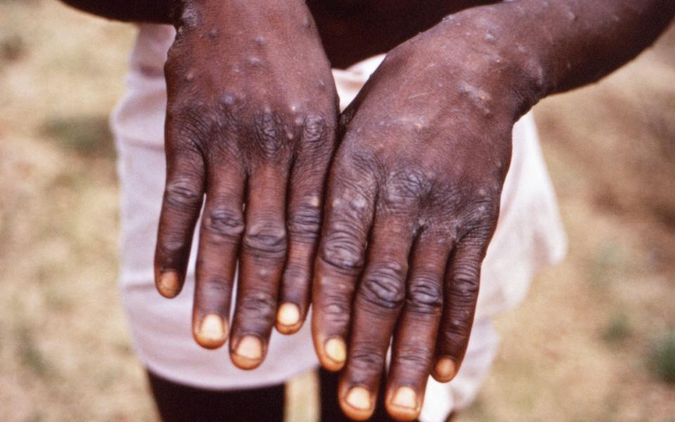 The hands of a monkeypox patient - RGB Ventures / SuperStock / Alamy/Alamy