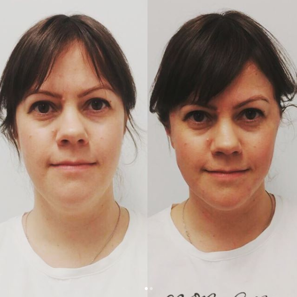 My face right before and straight after the jawlift. Really quite a dramatic change, Picture: Supplied