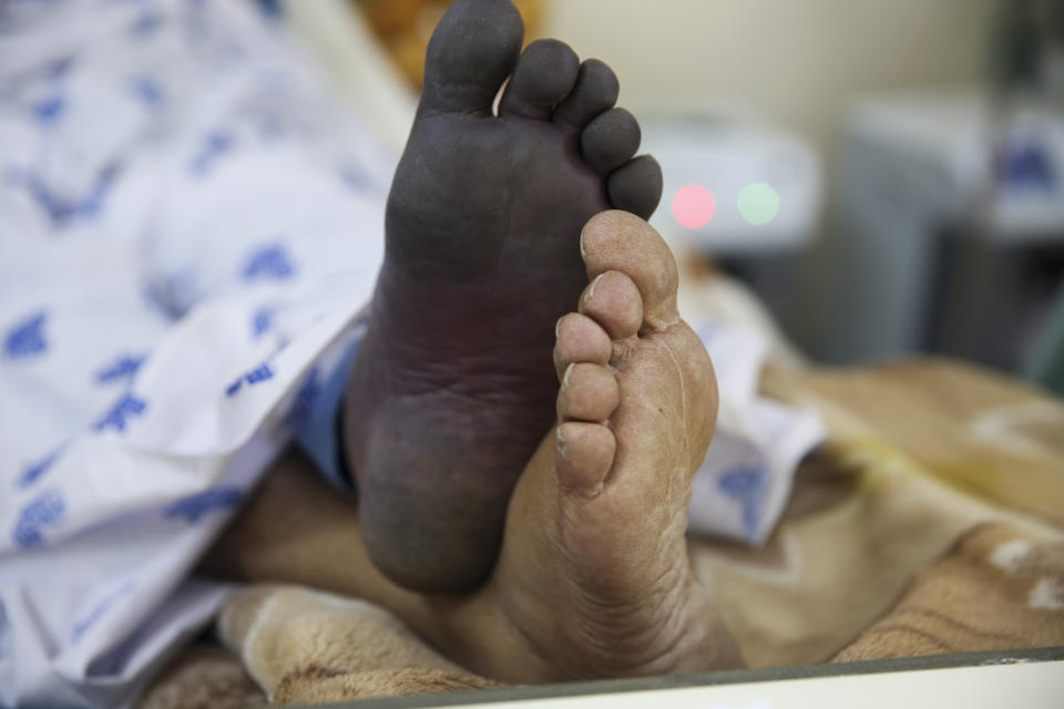 Mohammad Amin, whose left foot has turned black, is treated in the Intensive Care Unit ward for COVID-19 patients at the Afghan-Japan Communicable Disease Hospital in Kabul, Afghanistan, Tuesday June 30, 2020. (AP Photo/Rahmat Gul)