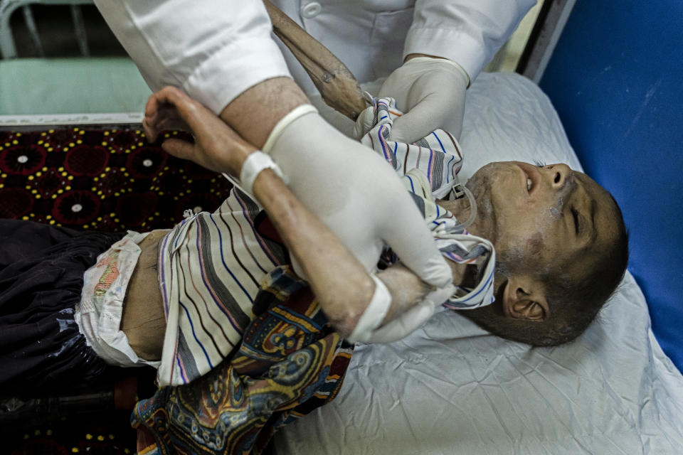 A doctor examines an acute malnourished boy at the Indira Gandhi hospital in Kabul, Afghanistan, Sunday, May 22, 2022. Some 1.1 million Afghan children under the age of five will face malnutrition by the end of the year. , as hospitals wards are already packed with sick children . (AP Photo/Ebrahim Noroozi)