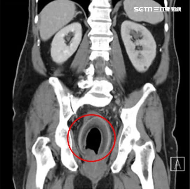 經電腦斷層掃描發現，男子直腸中有一個略帶空心的圓形物體，將尿道完全阻塞。（圖／義大醫院醫師陳致一提供）