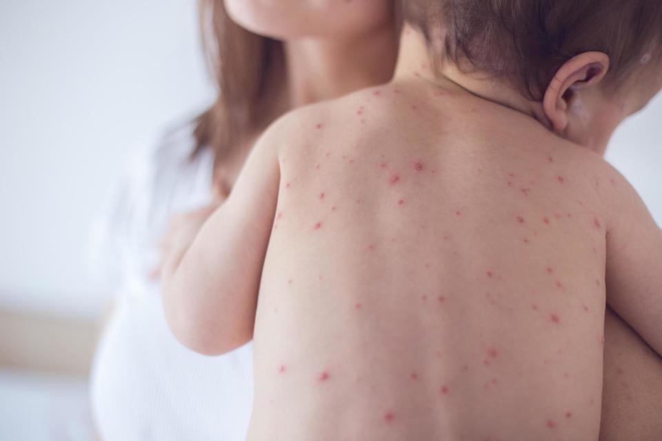 A mother is asking parents to vaccinate their children after son gets measles (Stock)