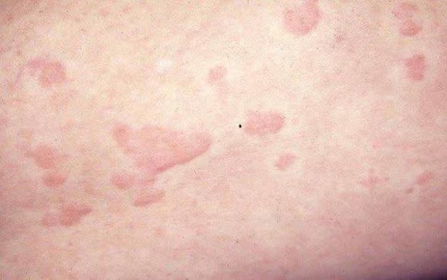 <p>Wikicommons</p> Hives (urticaria)