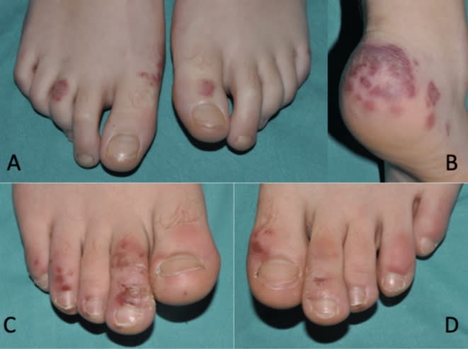 An image from the study "SARS‐CoV‐2 endothelial infection causes COVID‐19 chilblains: histopathological, immunohistochemical and ultraestructural study of 7 paediatric cases" links COVID-19 and a condition called "Covid Toes"