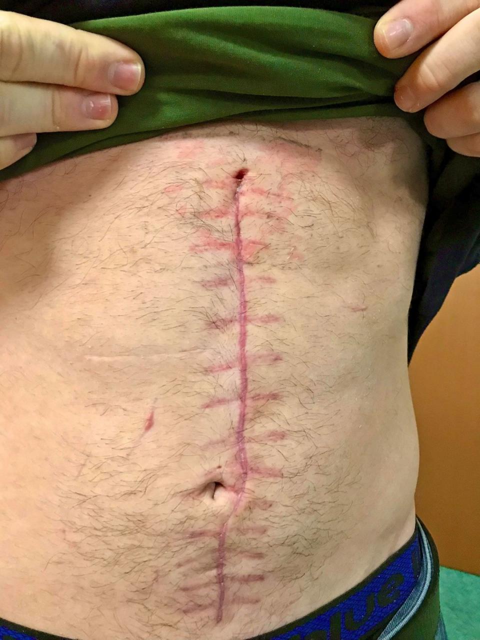 local and international volunteers support the resistance against the russian military in ukraine josh, a volunteer with the international legion, shows his surgical scar