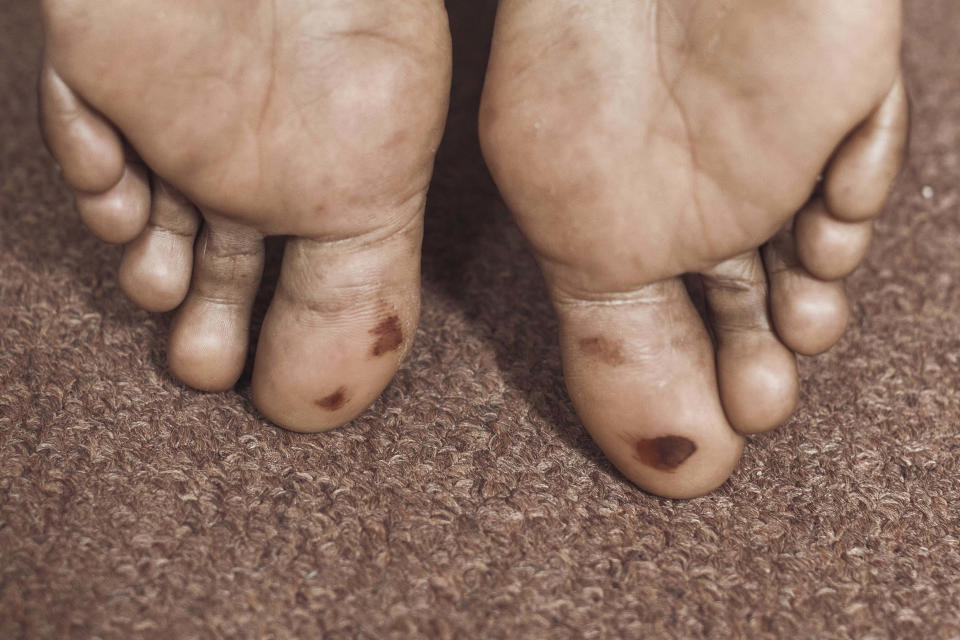 Abdoul, 32 year-old migrant from Maghama, Mauritania shows injuries on his feet from crossing the border at Texas at his shared apartment on Friday, Oct. 6, 2023, in New York. He was arrested in Eagle Pass, Texas' Shelby Park, a small piece of greenery touching the river with a ramp for boaters. It was the Fourth of July when Abdoul set foot on American soil for the first time. Officers standing nearby asked him a few questions and quickly took him into custody. (AP Photo/Andres Kudacki)